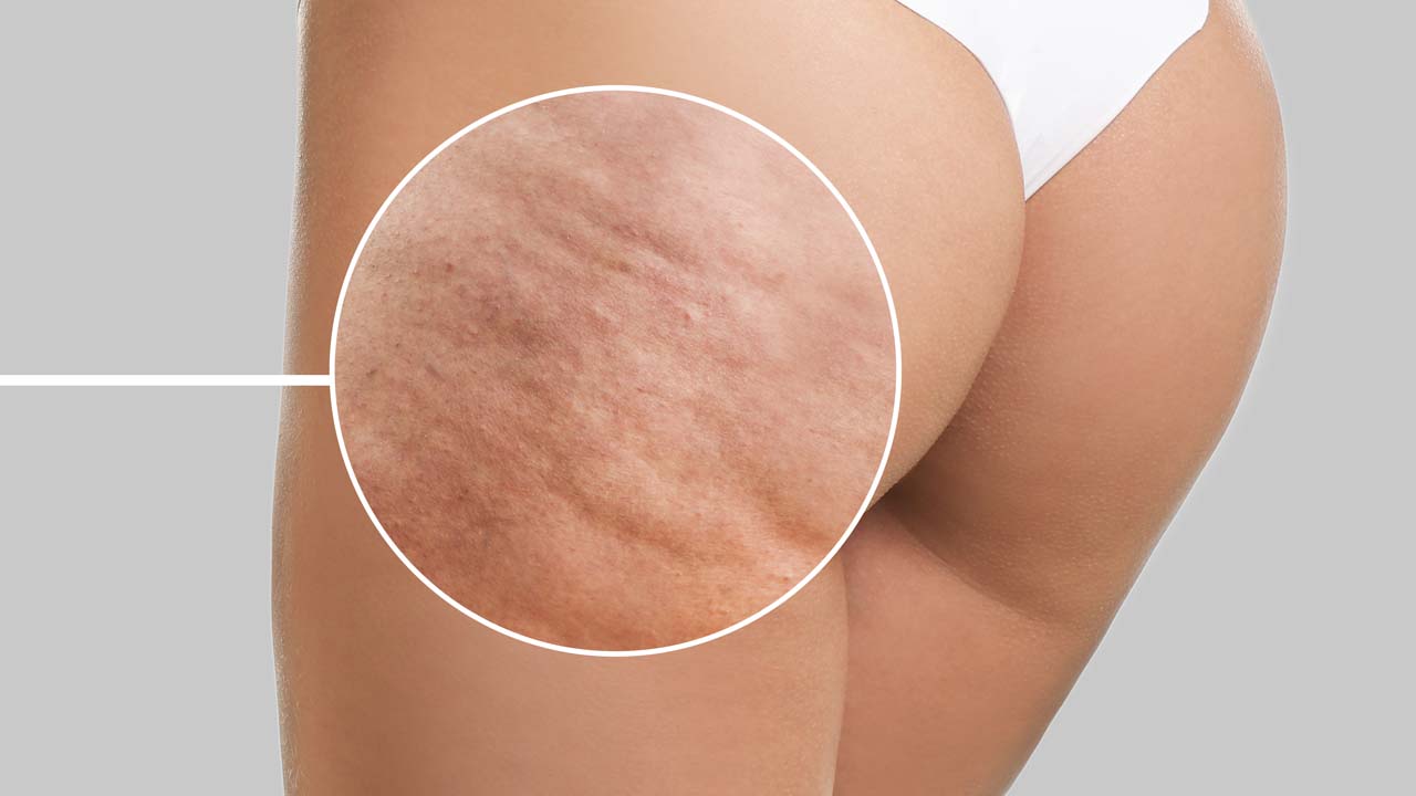 Worried About Cellulite? Safe Laser Therapy Can Help